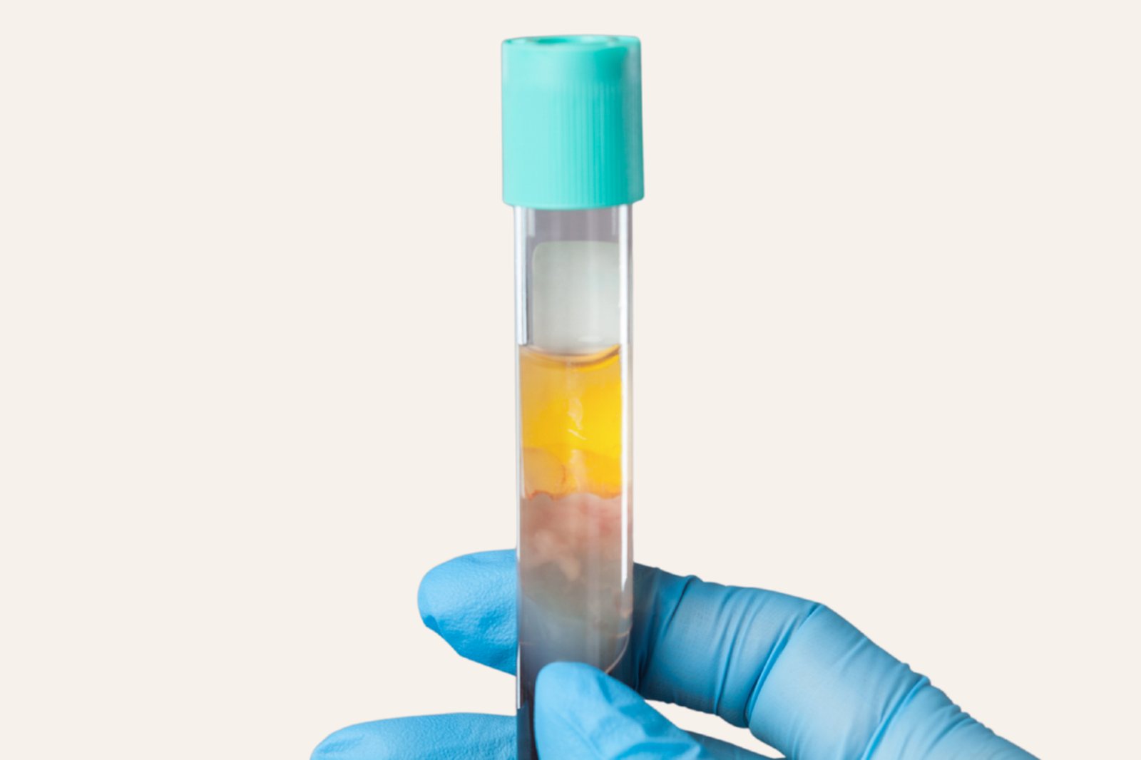 PRP Hair Restoration